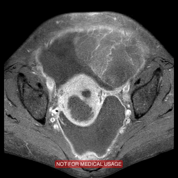 File:Adenocarcinoma of the cervix (Radiopaedia 28373-28615 Axial T1 C+ fat sat 12).jpg