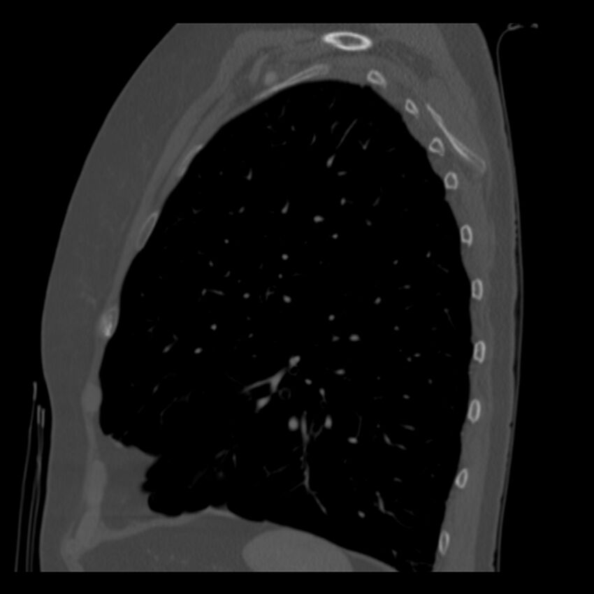 Adenocarcinoma of the lung (Radiopaedia 41015-43755 Sagittal bone window 81).jpg