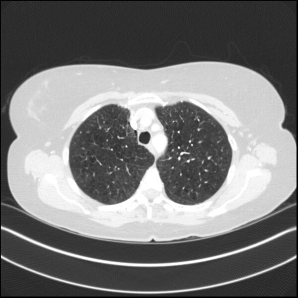 File:Adenocarcinoma of the lung (Radiopaedia 44205-47803 Axial lung window 26).jpg