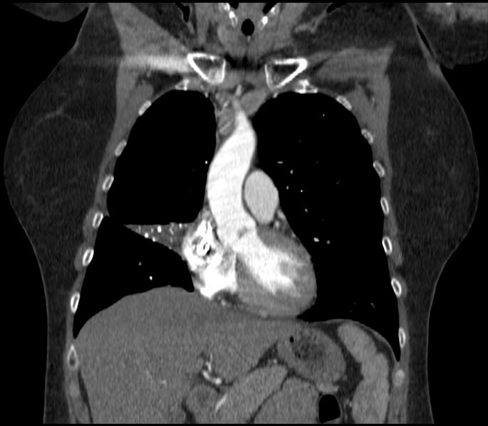 File:Adenocarcinoma of the lung (Radiopaedia 44205-47803 Coronal C+ portal venous phase 30).jpg