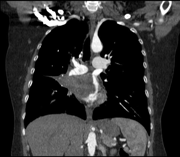File:Adenocarcinoma of the lung (Radiopaedia 44205-47803 Coronal C+ portal venous phase 46).jpg