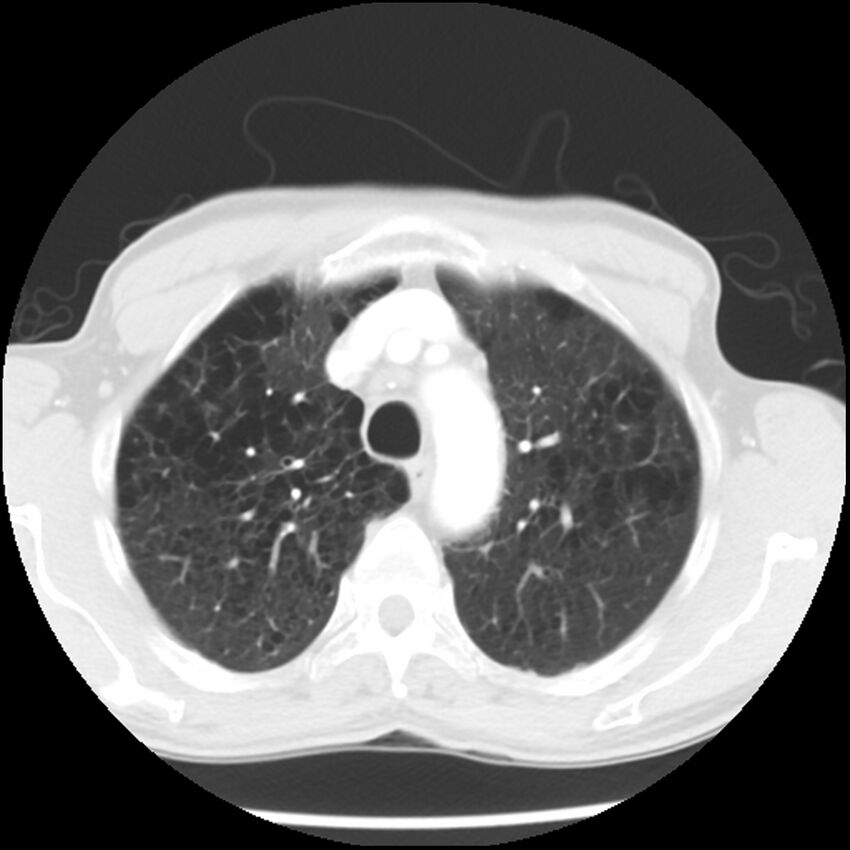 Adenocarcinoma of the lung - micropapillary predominant (Radiopaedia 42446-45563 Axial lung window 18).jpg