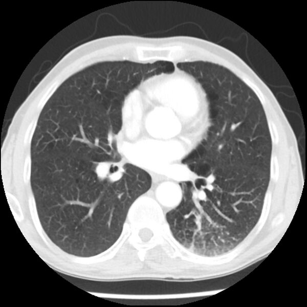 File:Adenocarcinoma of the lung - micropapillary predominant (Radiopaedia 42446-45563 Axial lung window 41).jpg