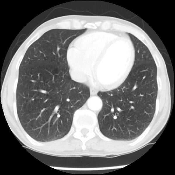 File:Adenocarcinoma of the lung - micropapillary predominant (Radiopaedia 42446-45563 Axial lung window 53).jpg