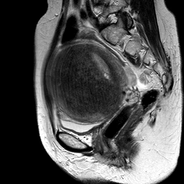 File:Adenomyoma of the uterus (huge) (Radiopaedia 9870-10438 Sagittal T2 13).jpg
