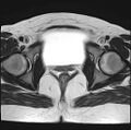 Adenomyosis - ovarian endometriomas (Radiopaedia 67031-76350 Axial T2 22).jpg