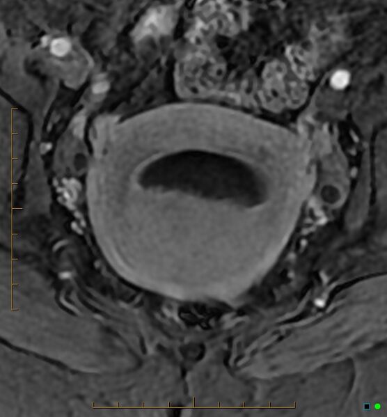 File:Adenomyosis uterus with hematometra (Radiopaedia 45779-50011 Axial T1 C+ fat sat 33).jpg