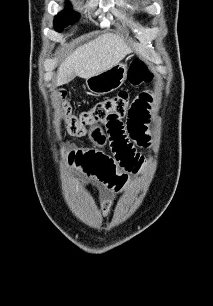 File:Adhesional small bowel obstruction (Radiopaedia 58900-66131 Coronal C+ portal venous phase 71).jpg