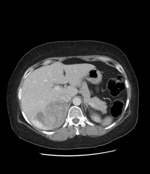 File:Adrenal cortical carcinoma with IVC invasion and thrombosis (Radiopaedia 34307-35597 Axial C+ portal venous phase 22).jpg