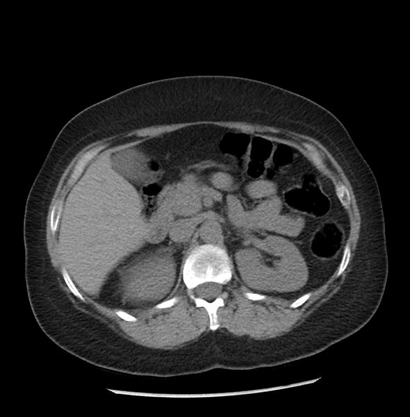 File:Adrenal cortical carcinoma with IVC invasion and thrombosis (Radiopaedia 34307-35597 Axial non-contrast 19).jpg