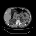 Adrenal myelolipoma (Radiopaedia 41843-44834 Axial non-contrast 25).jpg