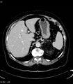 Adrenal myelolipoma (Radiopaedia 6765-7960 Axial C+ arterial phase 6).jpg