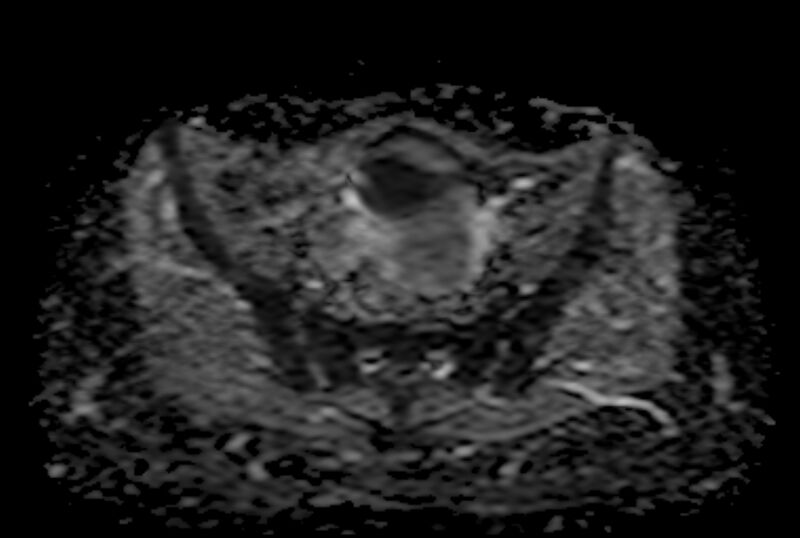 File:Adult granulosa cell tumor of the ovary (Radiopaedia 71581-81950 Axial ADC 11).jpg