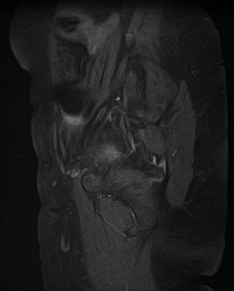 File:Adult granulosa cell tumor of the ovary (Radiopaedia 71581-81950 Sagittal T1 C+ fat sat 4).jpg