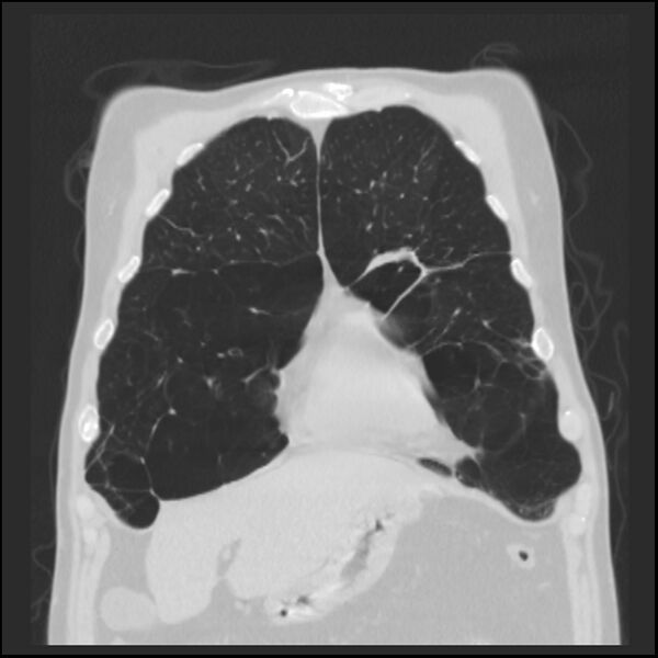 File:Alpha-1-antitrypsin deficiency (Radiopaedia 40993-43722 Coronal lung window 19).jpg