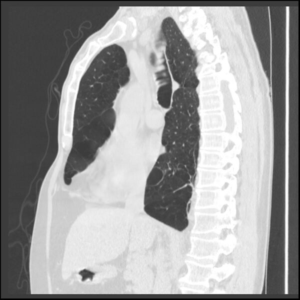 File:Alpha-1-antitrypsin deficiency (Radiopaedia 40993-43722 Sagittal lung window 146).jpg