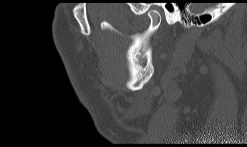 File:Ameloblastoma (Radiopaedia 33677-34806 Sagittal bone window 49).png
