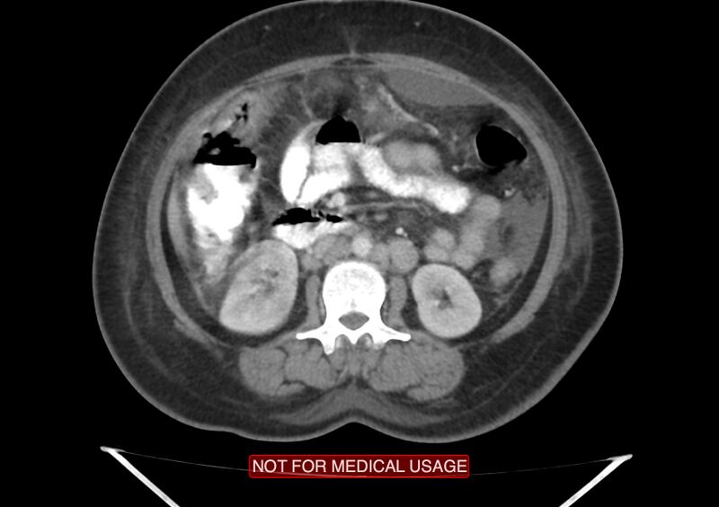 File:Amoebic enterocolitis with liver abscess (Radiopaedia 35100-36609 A 38).jpg