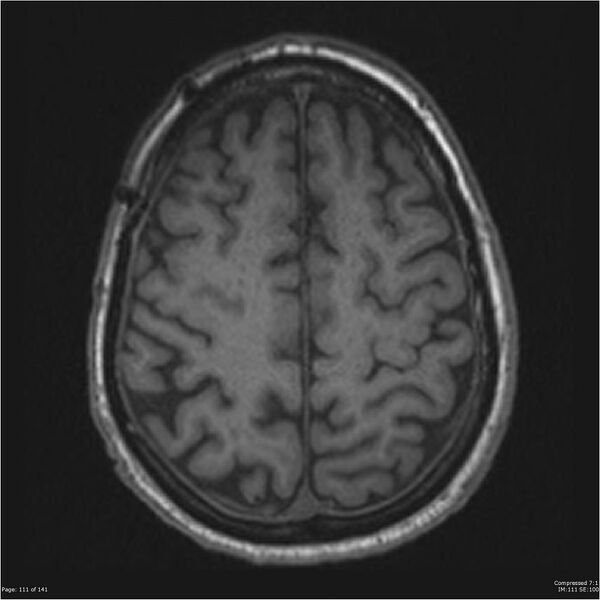 File:Anaplastic meningioma with recurrence (Radiopaedia 34452-35788 Axial T1 109).jpg