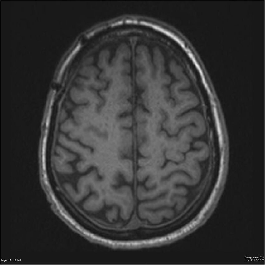 Anaplastic meningioma with recurrence (Radiopaedia 34452-35788 Axial T1 109).jpg