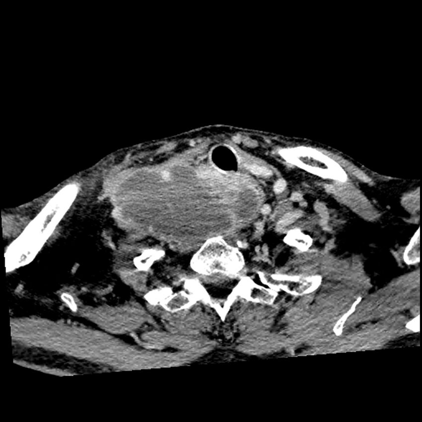 Anaplastic thyroid carcinoma (Radiopaedia 79087-92034 B 37).jpg