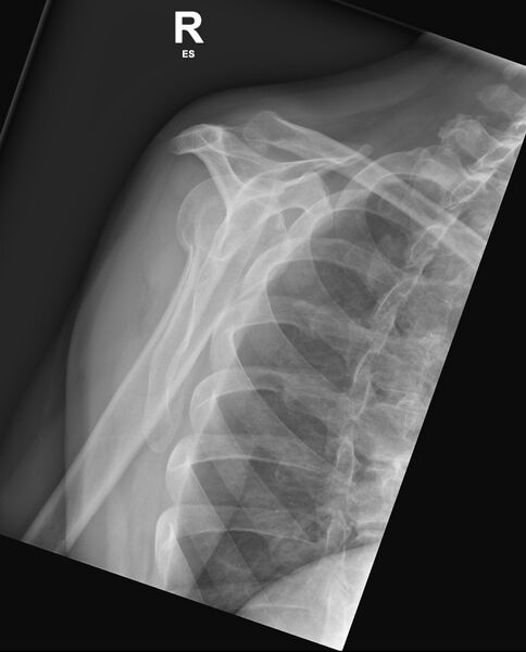 File:Anatomical neck of humerus fracture (Radiopaedia 66621-75918 Lateral 1).jpg