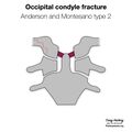 Anderson and Montesano classification of occipital condyle fractures (diagrams) (Radiopaedia 87203-103478 type 2 1).jpeg