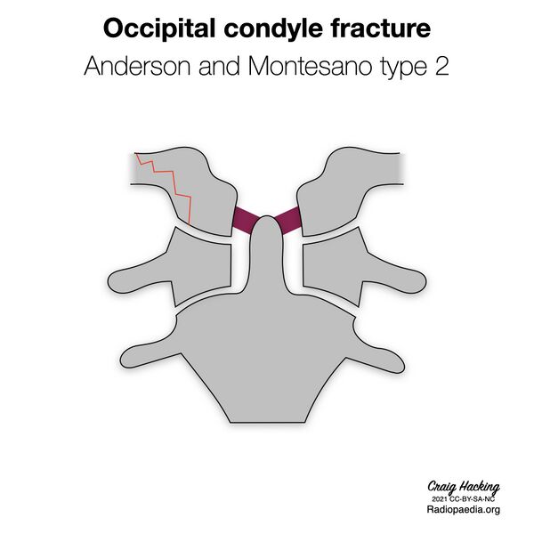 File:Anderson and Montesano classification of occipital condyle fractures (diagrams) (Radiopaedia 87203-103478 type 2 1).jpeg