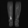 Aneurysmal bone cyst - tibia (Radiopaedia 22343-22367 Coronal STIR 12).jpg