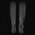 Aneurysmal bone cyst - tibia (Radiopaedia 22343-22367 Coronal STIR 14).jpg
