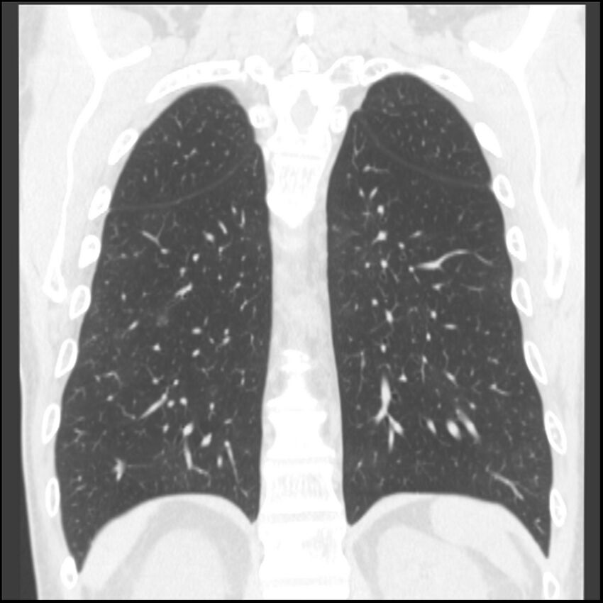 Angioinvasive aspergillosis (Radiopaedia 43957-47466 Coronal lung window 25).jpg