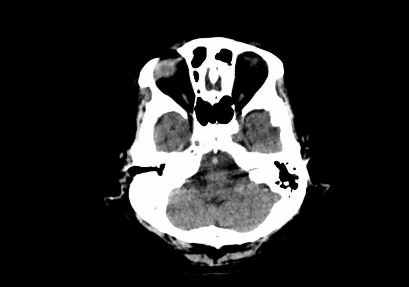 File:Anomalous intracranial venous drainage (Radiopaedia 28161-28418 Axial non-contrast 8).jpg