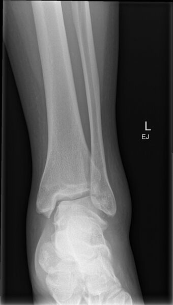 File:Anterior calcaneal process fracture (Radiopaedia 50110-55421 Frontal 1).jpg