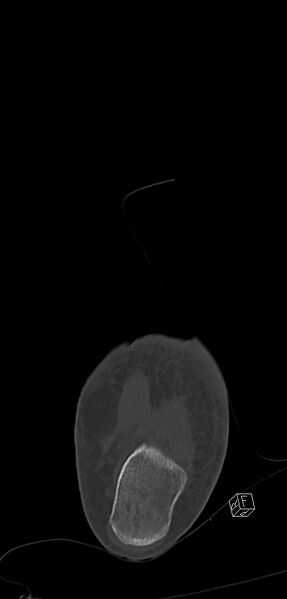 File:Anterior calcaneal process fracture (Radiopaedia 63353-71943 Coronal bone window 45).jpg