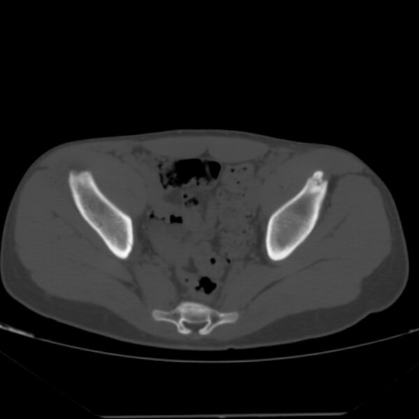 File:Anterior inferior iliac spine avulsion fracture (Radiopaedia 49469-54627 Axial bone window 27).jpg