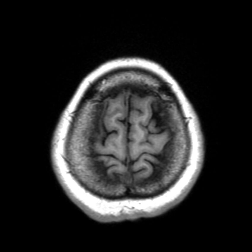 Anti-MOG encephalomyelitis (Radiopaedia 73831-84646 Axial T1 45).jpg