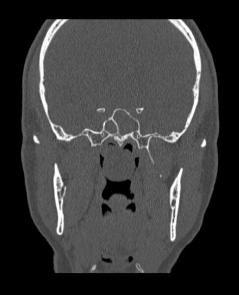 File:Antrochoanal polyp (Radiopaedia 79011-92169 Coronal bone window 18).jpg
