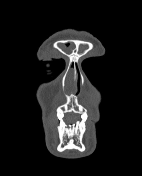 File:Antrochoanal polyp (Radiopaedia 79011-92169 Coronal bone window 81).jpg