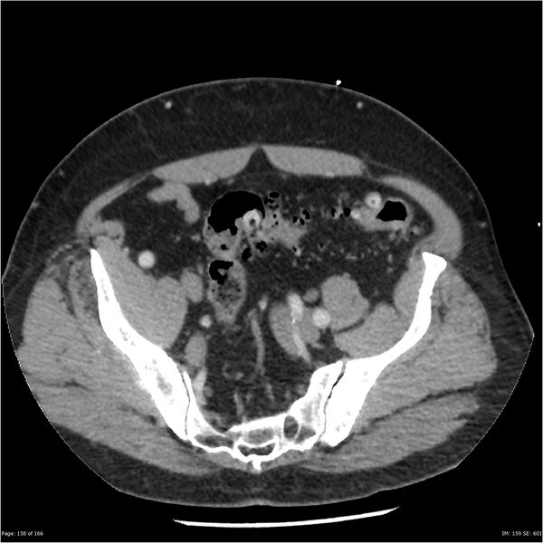 File:Aortic dissection- Stanford A (Radiopaedia 37759-39664 A 149).jpg