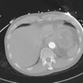 Aortic dissection - DeBakey type II (Radiopaedia 64302-73082 Axial lung window 55).png