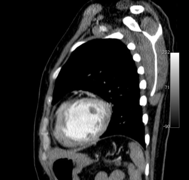 File:Aortic dissection - Stanford type A (Radiopaedia 29247-29659 C 5).jpg