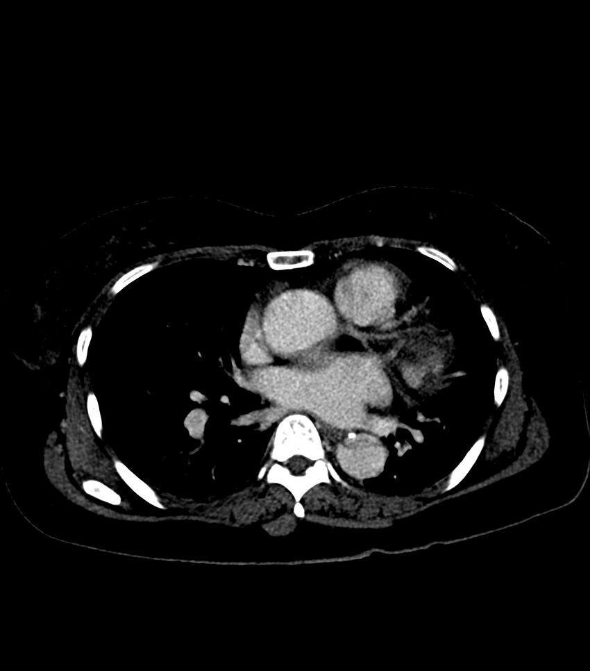 Aortic dissection with renal ischemia (Radiopaedia 76573-88338 B 15).jpg