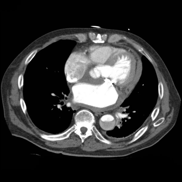 File:Aortic dissection with rupture into pericardium (Radiopaedia 12384-12647 A 35).jpg