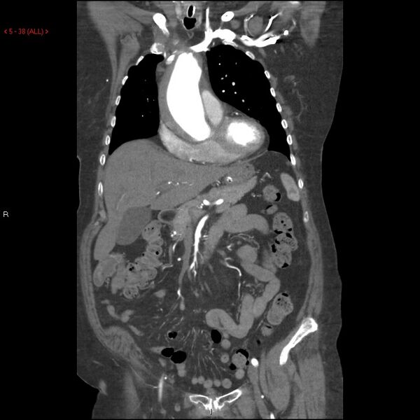 File:Aortic intramural hematoma (Radiopaedia 27746-28001 B 15).jpg