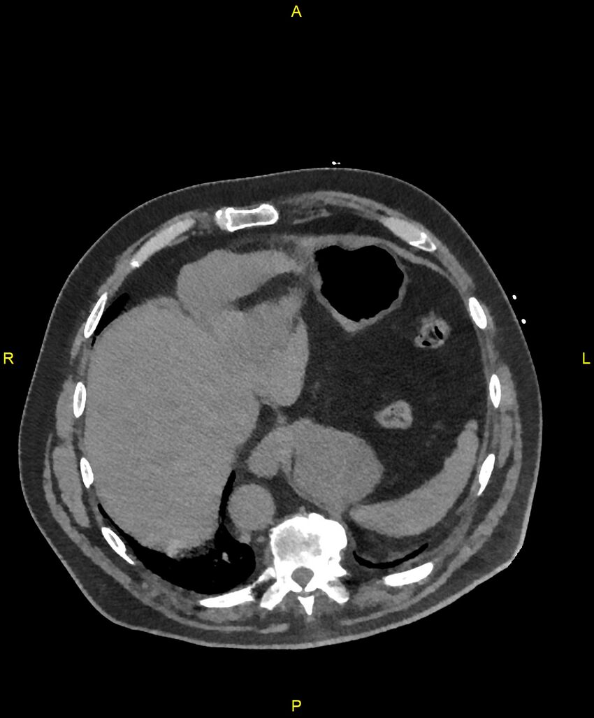 Aortic rupture (Radiopaedia 88822-105594 Axial non-contrast 201).jpg
