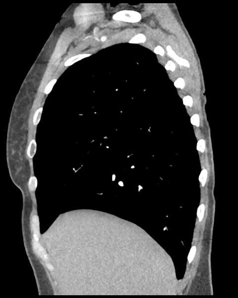 File:Aortic valve non-coronary cusp thrombus (Radiopaedia 55661-62189 D 41).png