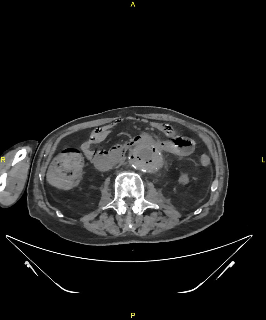 Aortoenteric fistula (Radiopaedia 84308-99603 Axial non-contrast 174).jpg