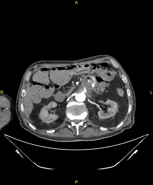 File:Aortoenteric fistula (Radiopaedia 84308-99603 B 118).jpg