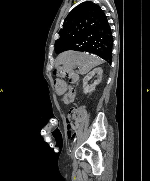 File:Aortoenteric fistula (Radiopaedia 84308-99603 C 105).jpg