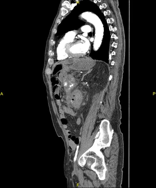 File:Aortoenteric fistula (Radiopaedia 84308-99603 C 222).jpg